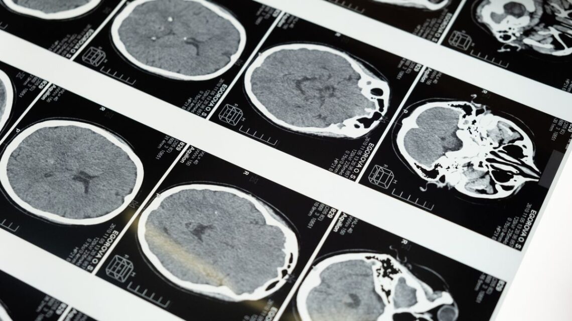 long COVID brain fog brain CT scan images 롱코비드 브레인포그