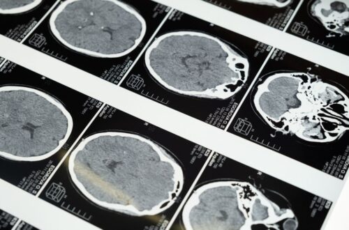 long COVID brain fog brain CT scan images 롱코비드 브레인포그