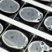 long COVID brain fog brain CT scan images 롱코비드 브레인포그